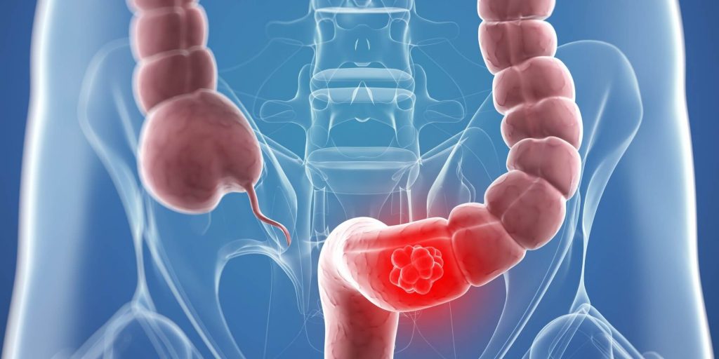 El cáncer de colon es el 4to cáncer mas frecuente del mundo y puede aparecer en hombres y mujeres de cualquier edad. Es completamente curable si es detectado a tiempo.