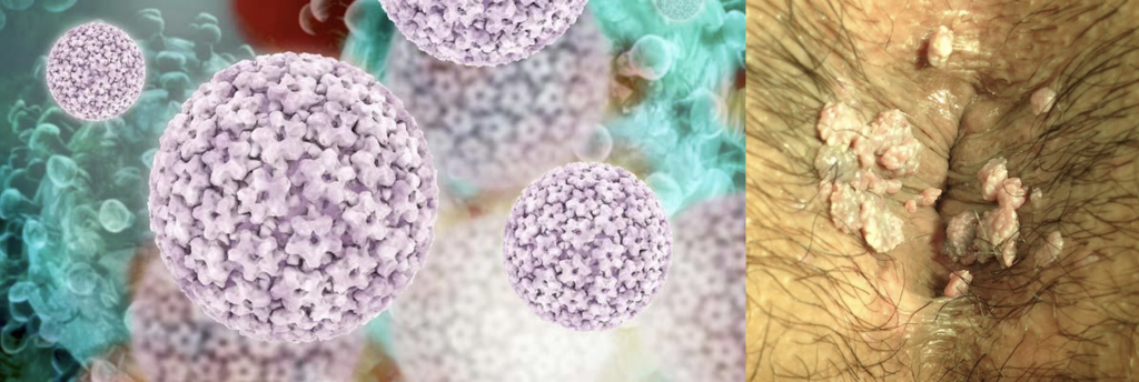 Tratamiento de hombres y mujeres portadores del Virus del Papiloma Humano en el ano.