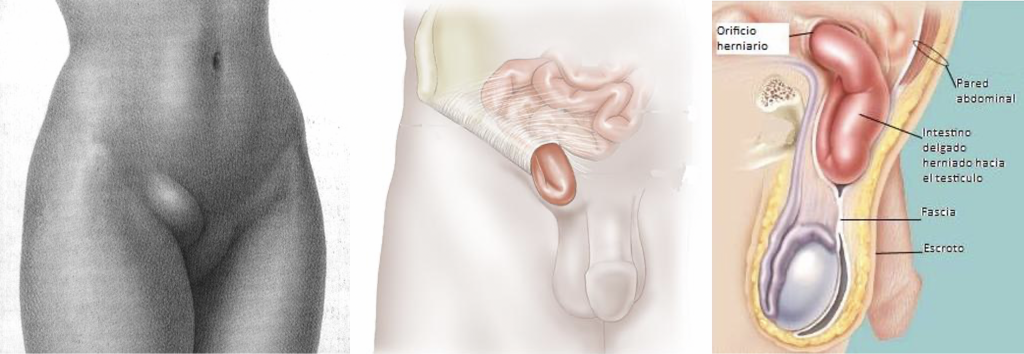 La Hernia Inguinal es una enfermedad muy frecuente en que una parte del contenido de la cavidad abdominal (grasa, intestinos, vejiga, apéndice, etc.) se sale a través de un orifico que se encuentra en la ingle y queda cubierto solo por piel.