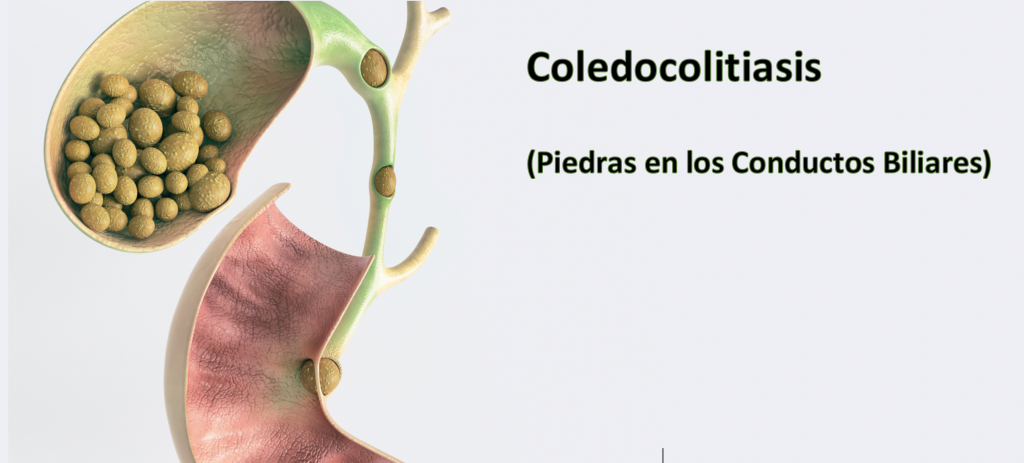 La Coledocolitiasis es la presencia de piedras en los conductos de las vías biliares. En nuestro país, la causa más frecuente es porque una persona tiene piedras en la vesícula que se han salido y atorado en los conductos de las vías biliares.