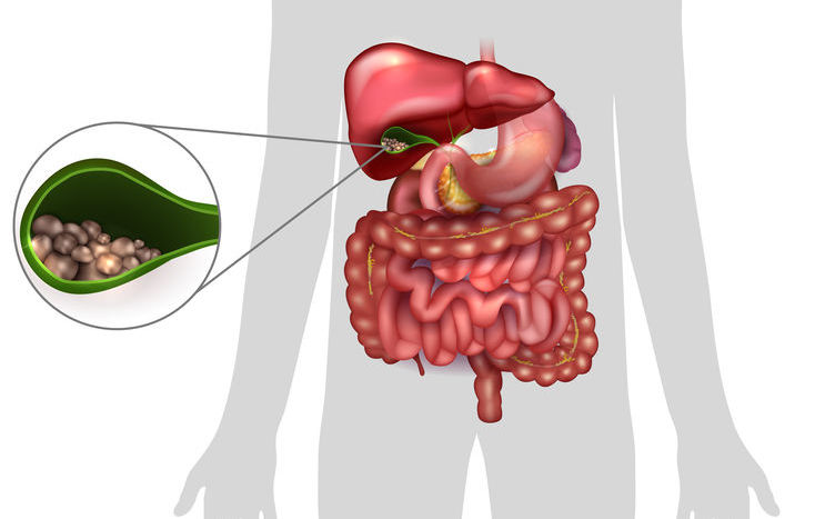 Colecistitis es la inflamación de la vesícula biliar. La causa más frecuente de que esto ocurra son piedras en la vesícula. Se necesita cirugía para retirar la vesícula.