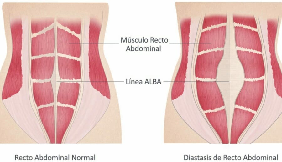 La Diástasis de Rectos es una alteración de la pared abdominal que implica una alteración estética mas que una enfermedad o dolor. Sin embargo, se puede corregir con cirugía.