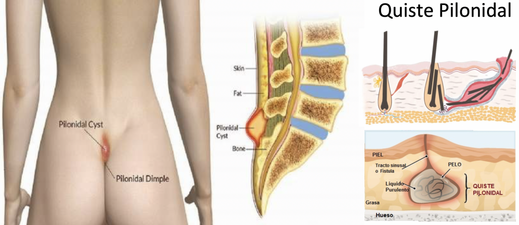 El Quiste Pilonidal es una enfermedad en la que varios pelos del propio cuerpo se entierran muy profundo en la piel y se quedan acumulados ahí, dentro de un quiste. Su localización más frecuente es en la parte más baja de la espalda o entre los glúteos.