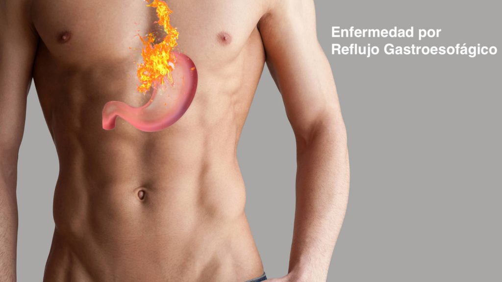 La Hernia Hiatal se refiere a que una parte del estómago 